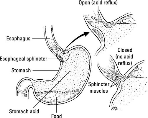 Wie die Ernährung bei saurem Reflux hilft